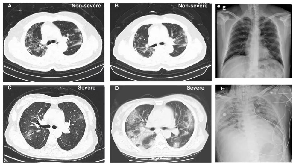新冠病毒CT28 新冠病毒CT值31严重吗