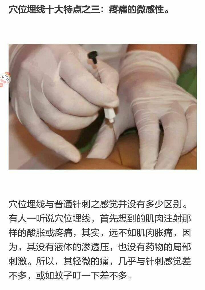 埋线减肥费用多少钱啊 埋线减肥费用多少钱啊知乎