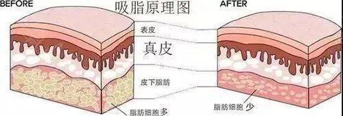 面部抽脂减肥 面部抽脂减肥价格多少