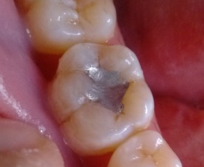 牙齿边上有个洞怎么办 牙齿边上有个洞怎么办不疼